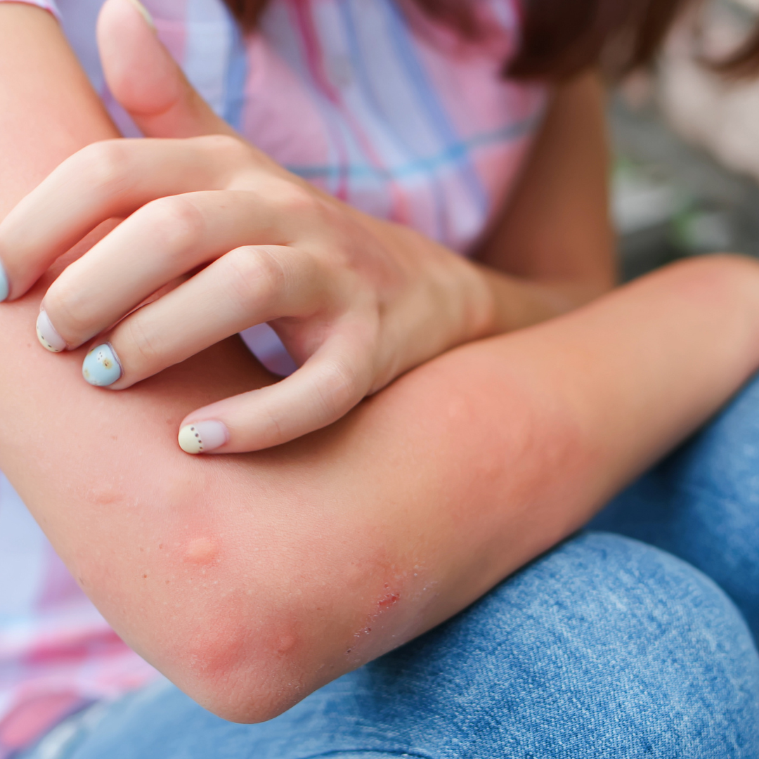 Children’s skin rashes and preventive measures